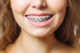 Braces