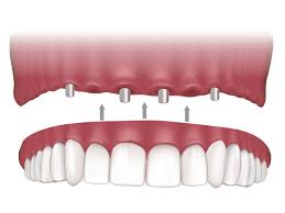 Dentures